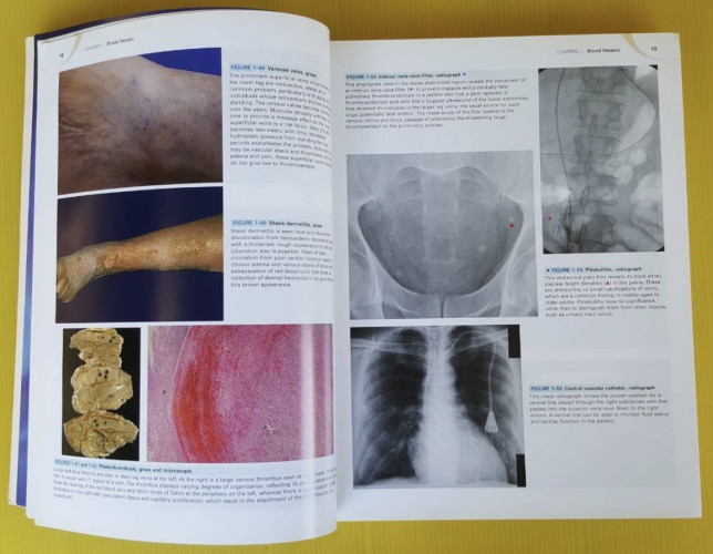Robbins and cotran atlas of pathology