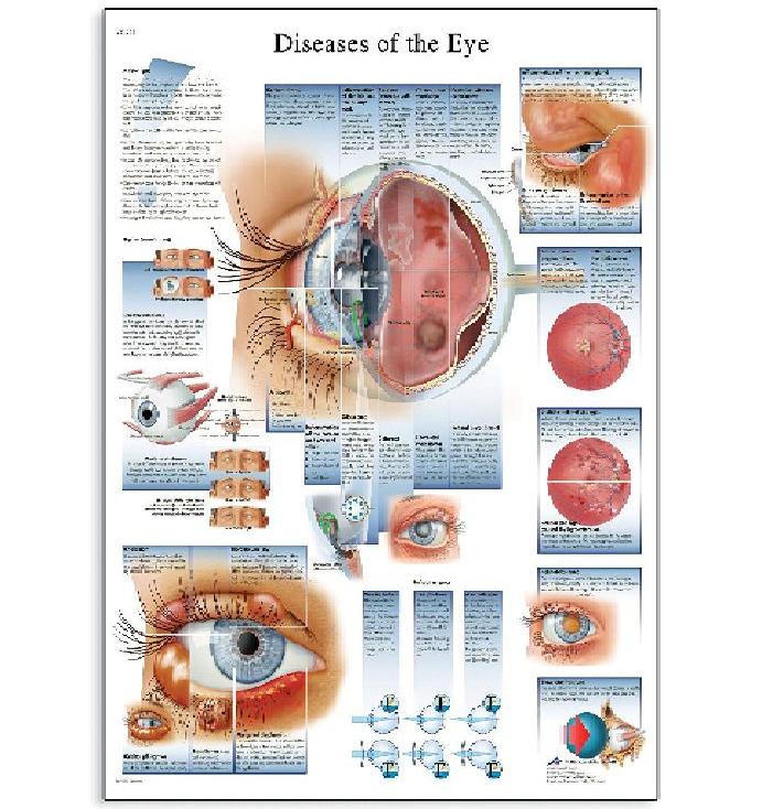 3B Scientific : 3BSVR1231L* โปสเตอร์รูปภาพ Diseases of The Eye Anatomical Chart